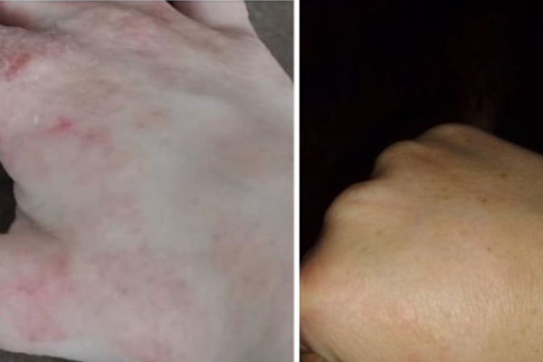 Poprawa stanu skóry przy AZS